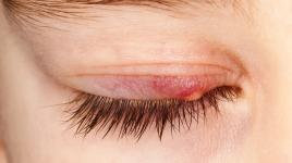 Babské rady na ječné zrno: přeslička pomoct může, ale sušenému kravinci se vyhni